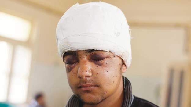 ಕಾಶ್ಮೀರದಲ್ಲಿ ಪೆಲ್ಲೆಟ್ ಗನ್ ಬಳಕೆ ನಿಲ್ಲಿಸಲು ಆಗ್ರಹಿಸಿ ಅಭಿಯಾನ