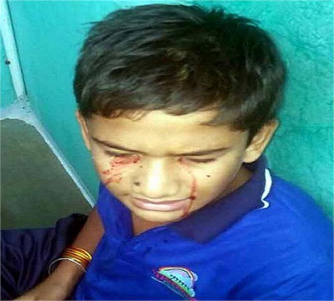 ಈ 13 ವರ್ಷದ ಹುಡುಗನಿಗೆ ರಕ್ತವೇ ಕಣ್ಣೀರು !