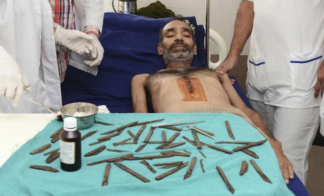 ಈತನ ಹೊಟ್ಟೆಯೊಳಗೆ ಎಷ್ಟು ಡಝನ್ ಚೂರಿಗಳಿದ್ದವು ಗೊತ್ತೆ?