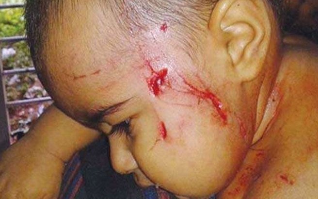 1ವರ್ಷದ ಮಗುವನ್ನು ಕಚ್ಚಿ ಎಳೆದೊಯ್ಯಲು ಪ್ರಯತ್ನಿಸಿದ ಬೀದಿ ನಾಯಿ!