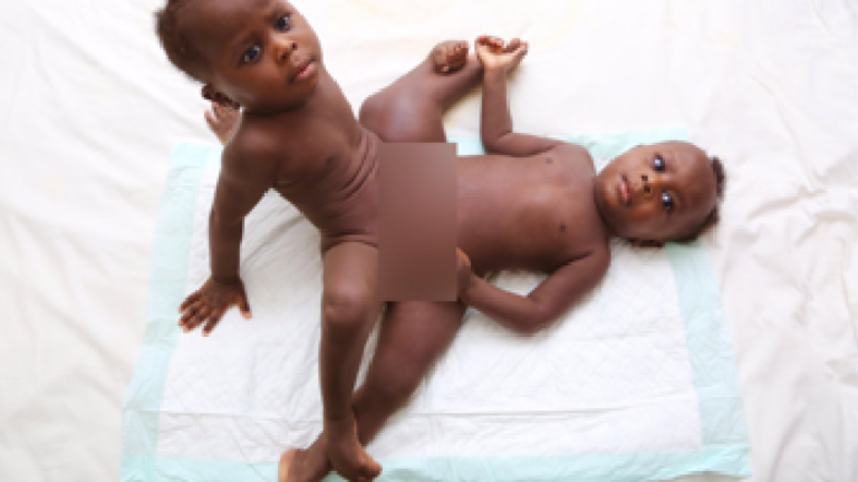 ಸುಡಾನೀ ಸಯಾಮಿ ಅವಳಿಗಳನ್ನು ಬೇರ್ಪಡಿಸಲು ವೈದ್ಯರು ಸಜ್ಜು