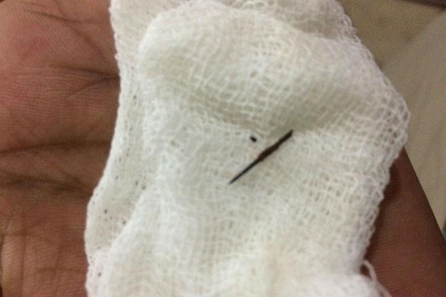 ವ್ಯಕ್ತಿಯ ದೇಹದಲ್ಲಿದ್ದ ಸೂಜಿಯನ್ನು 22 ವರ್ಷಗಳ ಬಳಿಕ ಹೊರತೆಗೆದರು