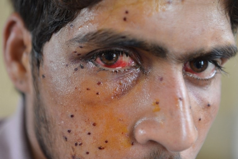 ಕಾಶ್ಮೀರ ಕಣಿವೆಯ ಬವಣೆಗಳು