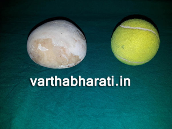 ಟೆನಿಸ್‌ಬಾಲ್ ಗಾತ್ರದ ಕಲ್ಲನ್ನು ತೆಗೆದ ನಂತರ ಸಾಮಾನ್ಯ ಜೀವನದತ್ತ ಕಾರ್ಕಳದ ರೋಗಿ
