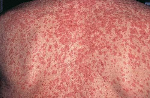 ದಡಾರ ಮತ್ತು ರುಬೆಲ್ಲಾ