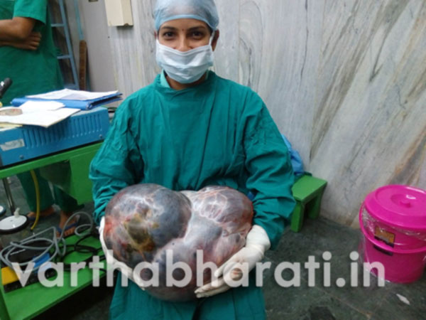 ಮಣಿಪಾಲ:16ಕೆ.ಜಿ.ಬೃಹತ್ ಅಂಡಾಶಯ ಗೆಡ್ಡೆ ಯಶಸ್ವಿ ಶಸ್ತ್ರಚಿಕಿತ್ಸೆ