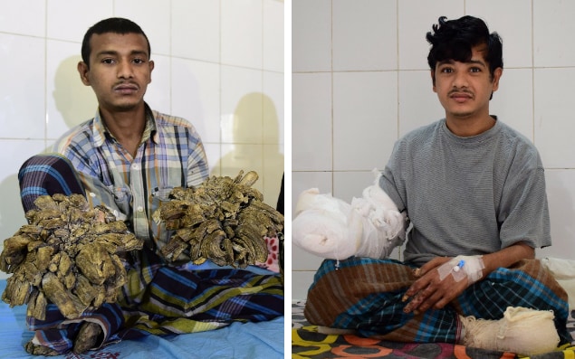 ‘ಟ್ರೀ ಮ್ಯಾನ್’ ಗೆ ಮರುಜನ್ಮ ನೀಡಿದ 16 ಶಸ್ತ್ರಕ್ರಿಯೆ!