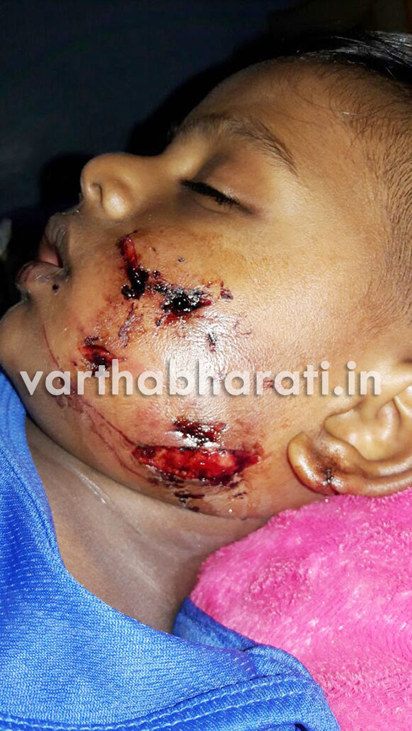 ​ಮಗುವಿನ ಮೇಲೆ ಹುಚ್ಚುನಾಯಿ ದಾಳಿ