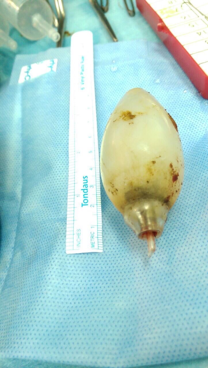 11 ವರ್ಷಗಳ ಹಿಂದೆ ವ್ಯಕ್ತಿ ನುಂಗಿದ್ದ ಬಲ್ಬ್ ಹೊರತೆಗೆದ ವೈದ್ಯರು !