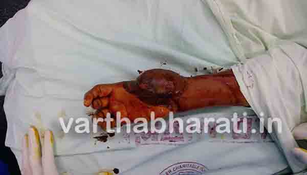 ಅಪಘಾತದಲ್ಲಿ ಕಳೆದುಕೊಂಡ ಹೆಬ್ಬೆರಳನ್ನು ಮರಳಿ ಪಡೆದ ಯುವಕ!