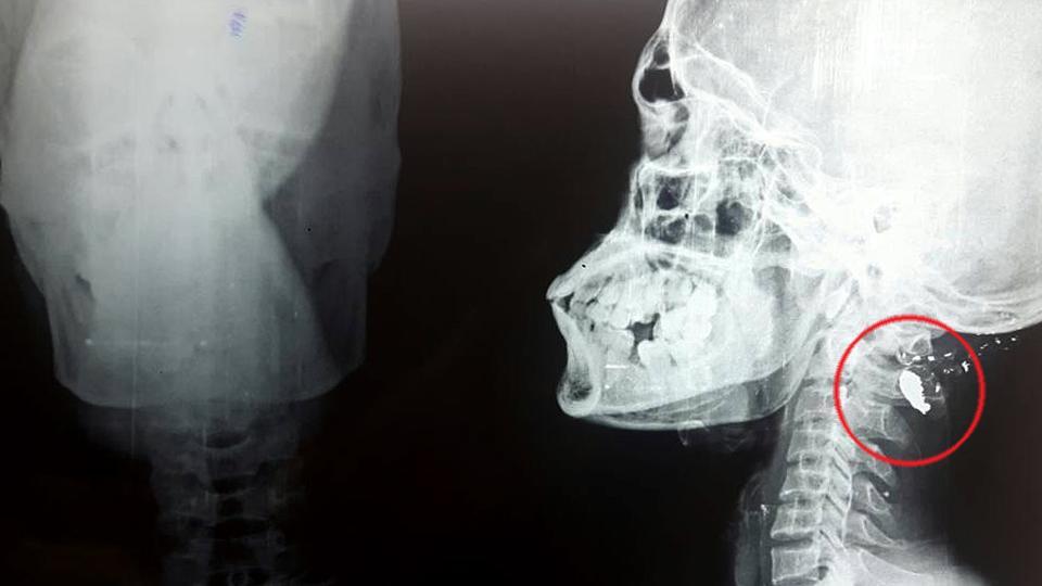 ಮೂತ್ರಶಂಕೆಗೆ ಹೋದವನ ತಲೆಗೆ ಗುಂಡು!