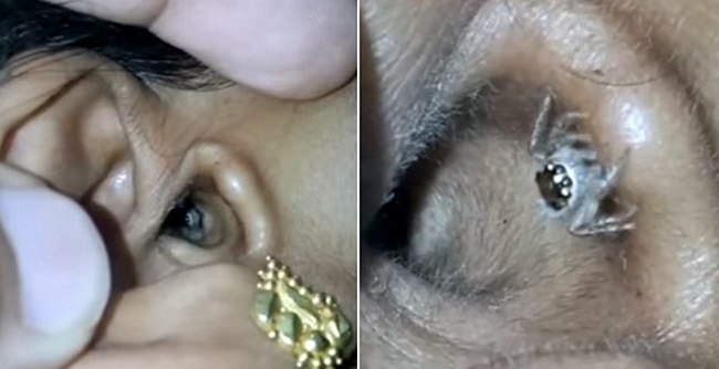 ಮಹಿಳೆಯ ಕಿವಿಯಿಂದ ತೆವಳುತ್ತಾ ಬಂತು ಜೇಡ !