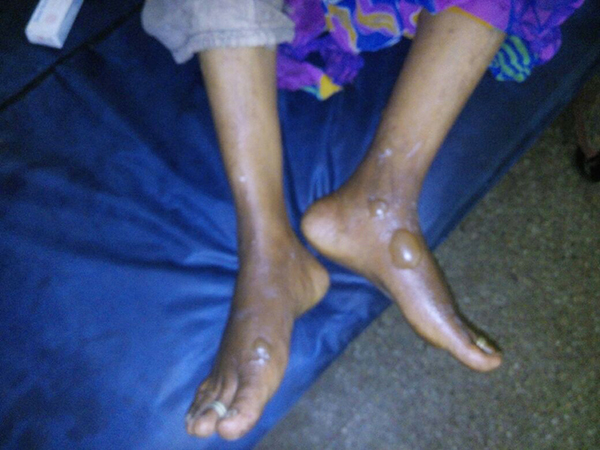 ಅನಿಲ ಸೋರಿಕೆ: ದಂಪತಿಗೆ ಗಾಯ