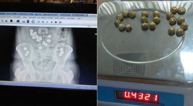 ಈತನ ಹೊಟ್ಟೆಯಲ್ಲಿ ಪತ್ತೆಯಾಯ್ತು 13 ಲಕ್ಷ ರೂ. ಮೌಲ್ಯದ ಚಿನ್ನ