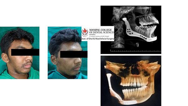 ಮಣಿಪಾಲ ಕೆಎಂಸಿಯಲ್ಲಿ ಅಪರೂಪದ ಮುಖದ ಶಸ್ತ್ರಚಿಕಿತ್ಸೆ