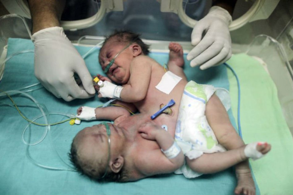 ಸೌದಿ: ಗಾಝಾದ ಸಯಾಮಿ ಅವಳಿಗಳನ್ನು ಬೇರ್ಪಡಿಸುವ ಶಸ್ತ್ರಚಿಕಿತ್ಸೆ ಯಶಸ್ವಿ