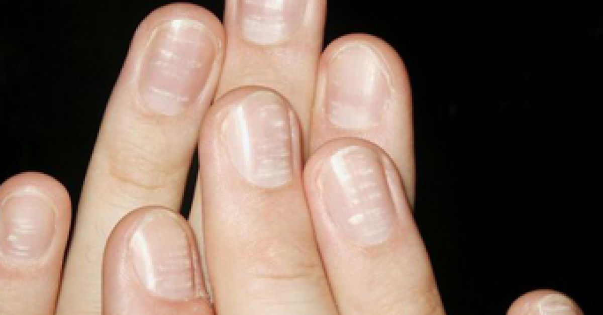 ಕ್ಯಾಲ್ಸಿಯಂ ಕೊರತೆಯನ್ನು ಸೂಚಿಸುವ ಈ ಲಕ್ಷಣಗಳು ನಿಮಗೆ ತಿಳಿದಿರಲಿ