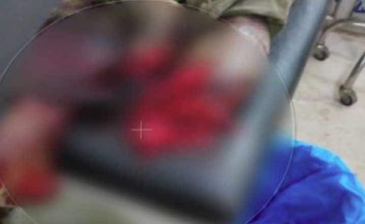 ವ್ಯಕ್ತಿಯ ತುಂಡಾದ ಪಾದವನ್ನು ಕಾಲುಗಳ ನಡುವೆ ಇಟ್ಟ ವೈದ್ಯರು!