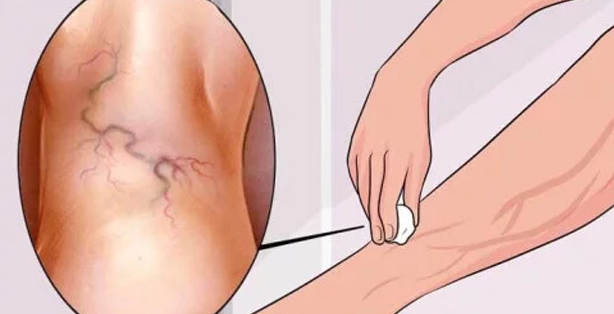 ವೇರಿಕೋಸ್ ವೇಯ್ನ್ಸ ಬಗ್ಗೆ ನಿಮಗೆಷ್ಟು ಗೊತ್ತು......?