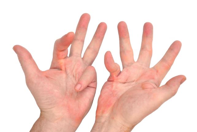 ವೈಕಿಂಗ್ ಕಾಯಿಲೆ ಎಂದರೇನು ? ಅದು ಹೇಗೆ ಉಂಟಾಗುತ್ತದೆ ?