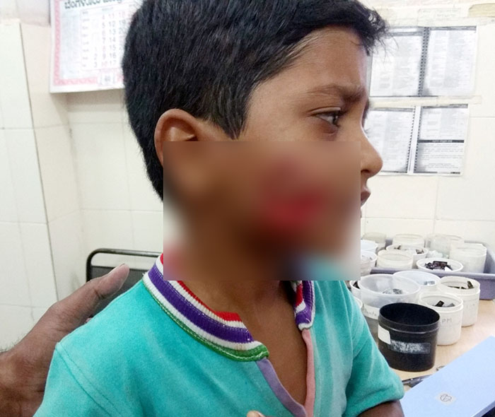 ಕೆ.ಆರ್.ಪೇಟೆ: ಬಾಲಕನ ಮೇಲೆ ಬೀದಿ ನಾಯಿ ದಾಳಿ