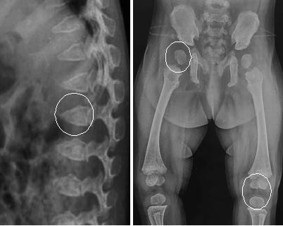ಮೂಳೆ ಬೆಳವಣಿಯನ್ನು ಕುಂಠಿತಗೊಳಿಸುವ ಅಪರೂಪದ ಹೊಸ ರೋಗ ಪತ್ತೆ ಹಚ್ಚಿದ ಮಣಿಪಾಲ ಜೆನೆಟಿಕ್ಸ್ ತಂಡ