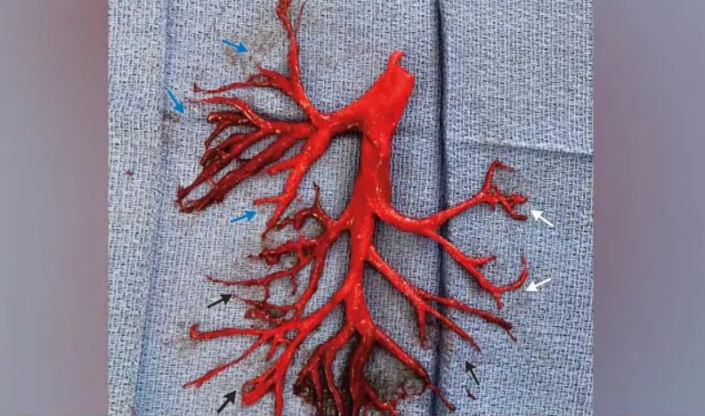 ರೋಗಿಯ ಬಾಯಿಯಿಂದ ಹೊರಬಂದ ರಕ್ತದ ಆಕೃತಿ ಕಂಡು ಅವಾಕ್ಕಾದ ವೈದ್ಯರು !