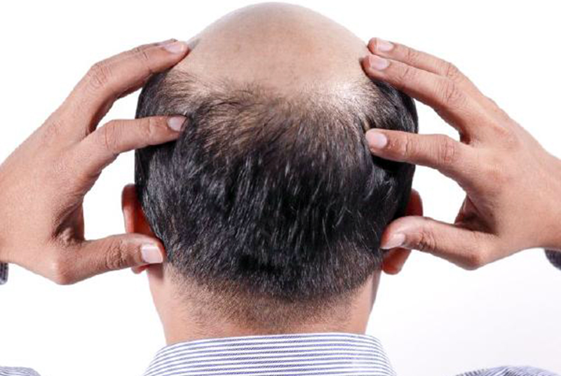 ಕೂದಲು ಕಸಿ ಮಾಡಿಸಿಕೊಂಡ ಎರಡೇ ದಿನದಲ್ಲಿ ಸಾವನ್ನಪ್ಪಿದ ಮುಂಬೈ ಉದ್ಯಮಿ