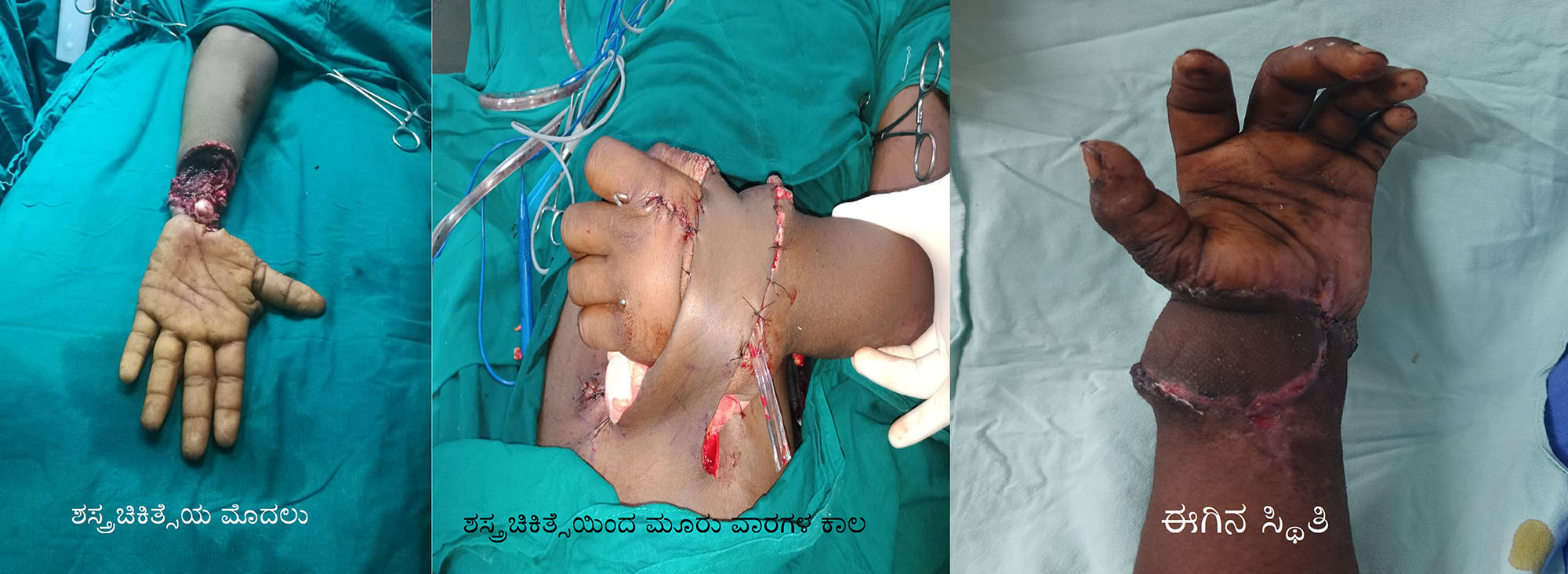 ಬಾಲಕನ ತುಂಡರಿಸಿದ ಕೈಜೋಡಿಸಿದ ಕೆಎಂಸಿ ವೈದ್ಯರು