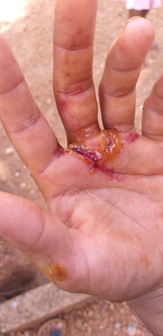 ಬಂಟ್ವಾಳ: ಹುಚ್ಚು ನಾಯಿ ದಾಳಿ; ಮೂರು ಮಂದಿಗೆ ಗಾಯ