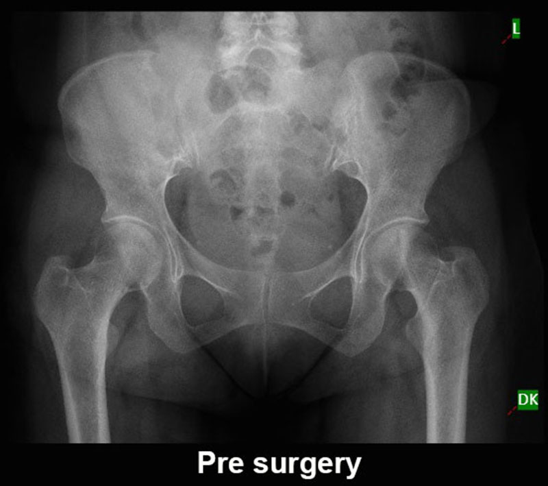 ಕೆಎಂಸಿ ವೈದ್ಯರ ಯಶಸ್ವಿ ಸಾಧನೆ: ಕಾಲು ಉಳಿಸುವ ಯಶಸ್ವಿ ಕ್ಯಾನ್ಸರ್ ಶಸ್ತ್ರಚಿಕಿತ್ಸೆ