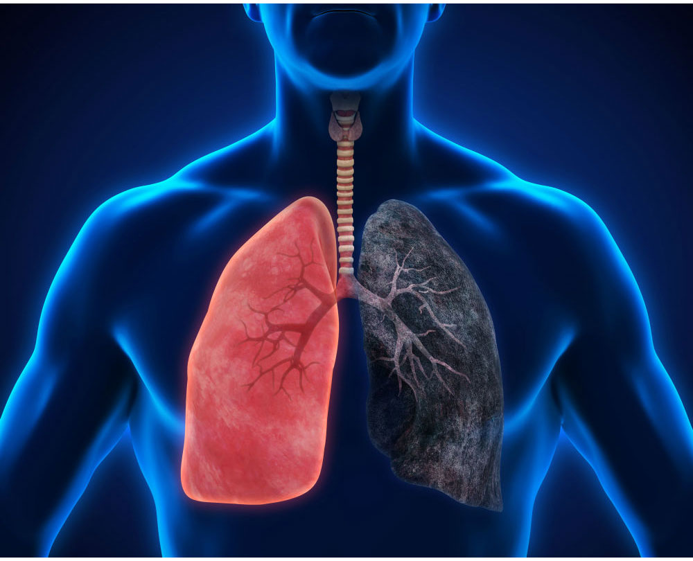 ಶ್ವಾಸಕೋಶ ಕ್ಯಾನ್ಸರ್‌ನ ಈ ಎಂಟು ಲಕ್ಷಣಗಳು ನಿಮಗೆ ತಿಳಿದಿರಲಿ