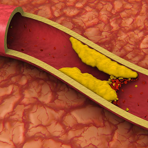 ಕೊಲೆಸ್ಟ್ರಾಲ್ ಅಪಾಯಗಳು
