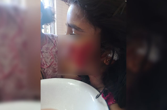 ಮೈಸೂರು: ಹುಚ್ಚು ನಾಯಿ ಕಡಿದು ಐವರು ಮಕ್ಕಳಿಗೆ ಗಾಯ, ಬಾಲಕಿಯ ಸ್ಥಿತಿ ಗಂಭೀರ