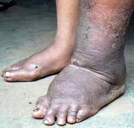 ರಾಜ್ಯದ ಪ್ರಥಮ ಆನೆಕಾಲು ರೋಗ ಮುಕ್ತ ಜಿಲ್ಲೆಯಾಗುವತ್ತ ಉಡುಪಿ