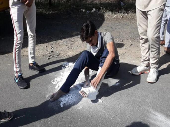 ಕಾಲಿಗೆ ಗಂಭೀರ ಗಾಯವಾಗಿದ್ದರೂ ಪ್ಲಾಸ್ಟರ್ ತೆಗೆದು ಮನೆಯತ್ತ ಹೊರಟ ವಲಸಿಗ ಕಾರ್ಮಿಕನ ಫೋಟೊ ವೈರಲ್