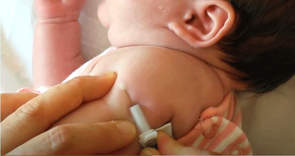 ಬಿಸಿಜಿ ಲಸಿಕೆ ಕಡ್ಡಾಯಗೊಳಿಸಿದ ದೇಶಗಳಲ್ಲಿ ಕೋವಿಡ್ ಸಾವಿನ ಪ್ರಮಾಣ ಕಡಿಮೆ !