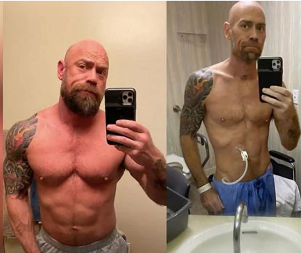 ಕೊರೋನ ಪರಿಣಾಮ: ಆಘಾತಕಾರಿ ಫೋಟೊ ಶೇರ್ ಮಾಡಿದ ಗುಣಮುಖನಾದ ವ್ಯಕ್ತಿ