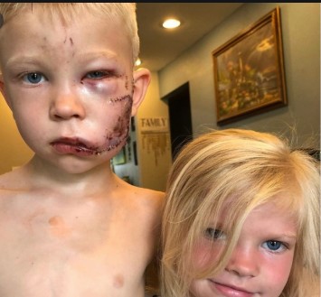 ಪುಟ್ಟ ಸೋದರಿಯನ್ನು ನಾಯಿ ದಾಳಿಯಿಂದ ರಕ್ಷಿಸಿದ ಪೋರನ ಮುಖಕ್ಕೆ 90ಕ್ಕೂ ಹೆಚ್ಚು ಹೊಲಿಗೆ!