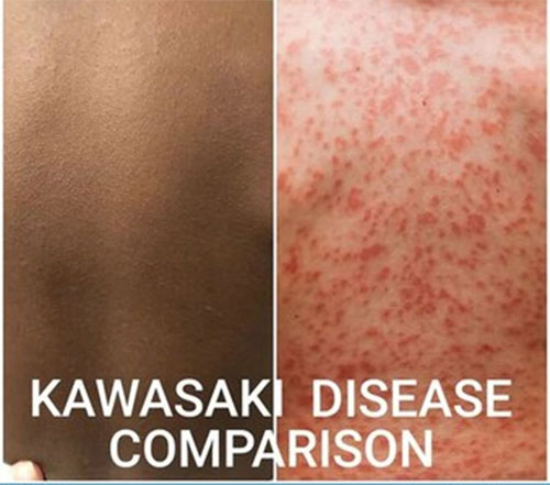 ಬಿಳಿ ಮತ್ತು ಬಿಳಿಯೇತರ ಚರ್ಮದ ರೋಗ ಲಕ್ಷಣಗಳು ಭಿನ್ನ ಎಂದು ಸಾಧಿಸಿದ ಕರಿಯ ವೈದ್ಯಕೀಯ ವಿದ್ಯಾರ್ಥಿ