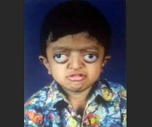 ಮಂಗಳೂರು: ಅಪರೂಪದ ಕಾಯಿಲೆ ಪೀಡಿತ ಬಾಲಕನ ನೆರವಿಗೆ ಮನವಿ