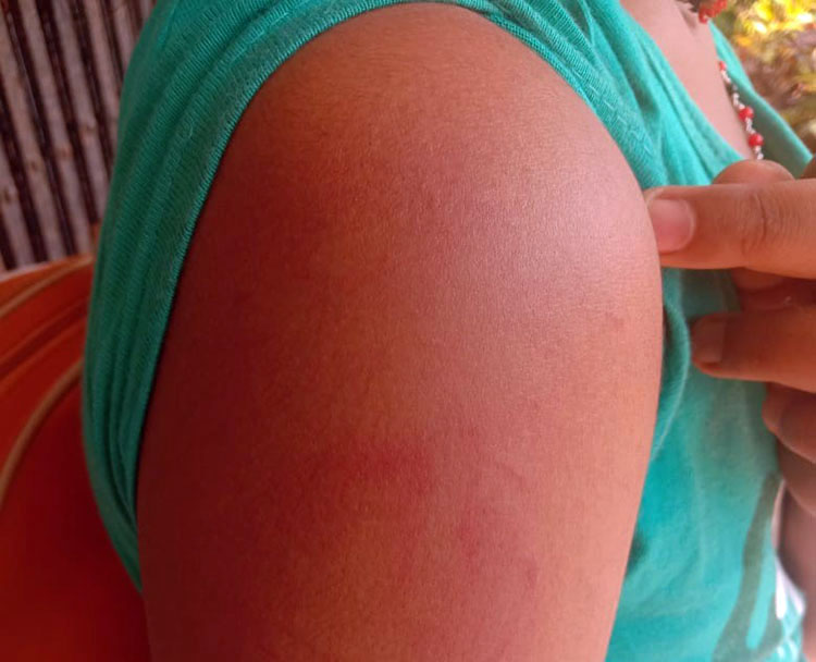 ​ಬ್ರಹ್ಮಾವರ: ತಾಯಿಯಿಂದ ಥಳಿತ: ಎಂಟು ವರ್ಷದ ಬಾಲಕಿಯ ರಕ್ಷಣೆ