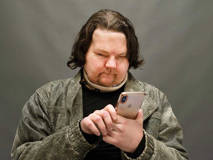 ವ್ಯಕ್ತಿಗೆ ಬೇರೆಯವರ ಮುಖ, 2 ಕೈ ಜೋಡಣೆ: ಅಮೆರಿಕದಲ್ಲಿ ವೈದ್ಯಲೋಕದ ಪವಾಡ