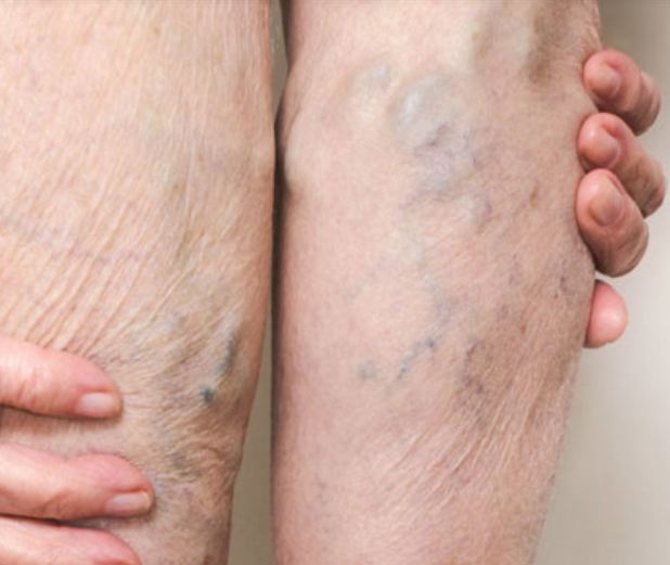 ವೆರಿಕೋಸ್ ವೇನ್ಸ್‌ನಿಂದ ಪಾರಾಗಲು ಕೆಲವು ಸರಳ ಉಪಾಯಗಳಿಲ್ಲಿವೆ