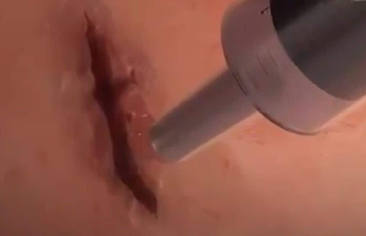 ಆಪರೇಷನ್‌ ಮಾಡಿದ ಬಳಿಕ ಹೊಲಿಗೆ ಬೇಕಿಲ್ಲ, ಈ ಗಮ್‌ ಸಾಕು!