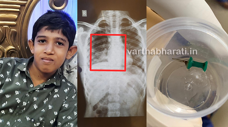 ಮಂಗಳೂರು: ಬಾಲಕನಿಗೆ ಉಸಿರಾಟ ತೊಂದರೆ; ಎಕ್ಸ್‌ರೇ ತೆಗೆದಾಗ ಶ್ವಾಸಕೋಶದಲ್ಲಿ ಗುಂಡುಸೂಜಿ ಪತ್ತೆ!