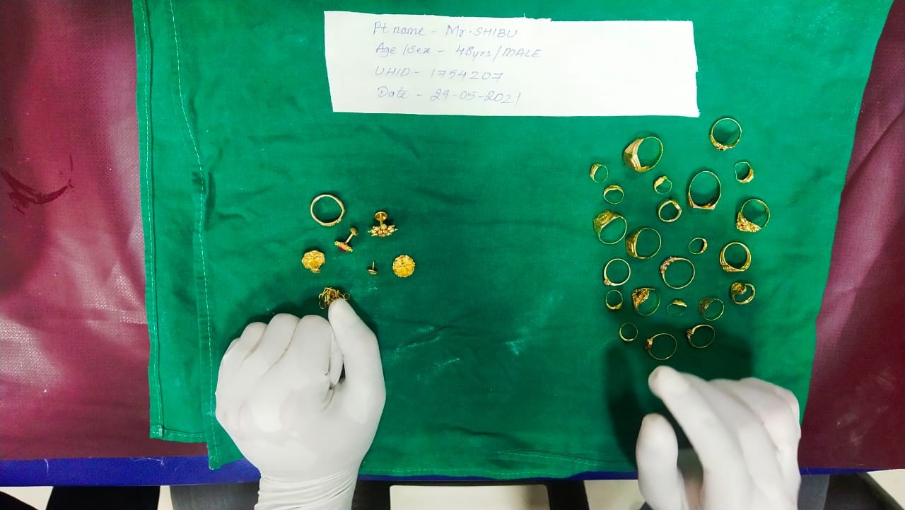 ಸುಳ್ಯ: ಕಳವು ಆರೋಪಿಯ ಹೊಟ್ಟೆಯಲ್ಲಿ 35 ಗ್ರಾಂ ಚಿನ್ನ ಪತ್ತೆ