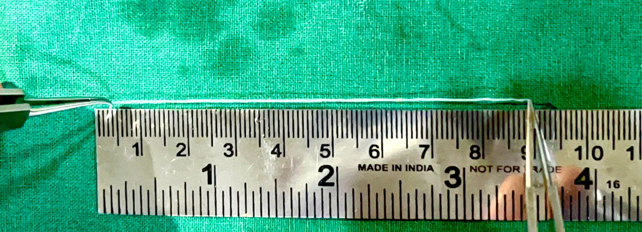 ಉಡುಪಿ: ವೃದ್ಧೆಯ ಕಣ್ಣಿನಲ್ಲಿ 9 ಸೆಂ.ಮೀ. ಉದ್ದದ ಜೀವಂತ ಹುಳ ಪತ್ತೆ !