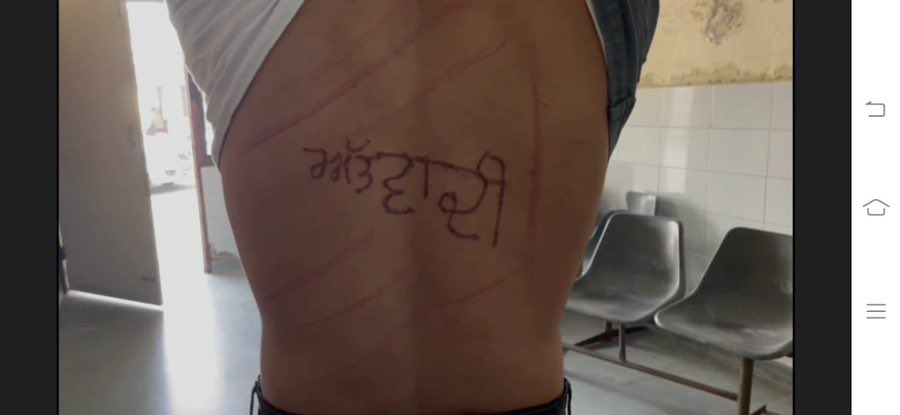 ಆತಂಕವಾದಿ ಎಂದು ಬರೆದು ಬೆನ್ನಿಗೆ ಬರೆ ಹಾಕಿದ ಜೈಲಿನ ಅಧೀಕ್ಷಕ: ವಿಚಾರಣಾಧೀನ ಕೈದಿಯ ಆರೋಪ