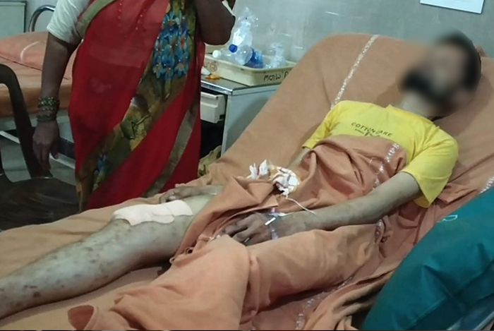 ಶಿವಮೊಗ್ಗ ಸ್ಮಾರ್ಟ್ ಸಿಟಿ ಕಾಮಗಾರಿಯ ಗುಂಡಿಗೆ ಬಿದ್ದು ಕಾಲು ಮುರಿದುಕೊಂಡ ಅಂಧ ವ್ಯಕ್ತಿ!